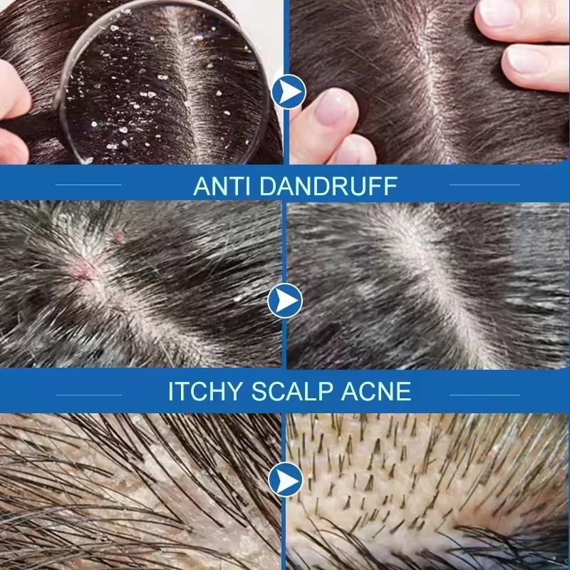 Fast Anti Dandruff Hair Treatm - Castor Oil Soap 评论和价格